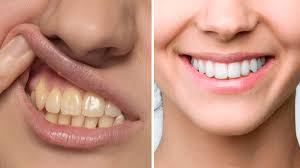 POLVO DE CARBON BLANQUEADOR DENTAL